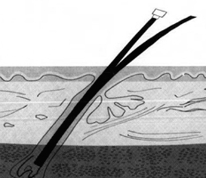 Electrolysis permanently eliminates unwanted hair